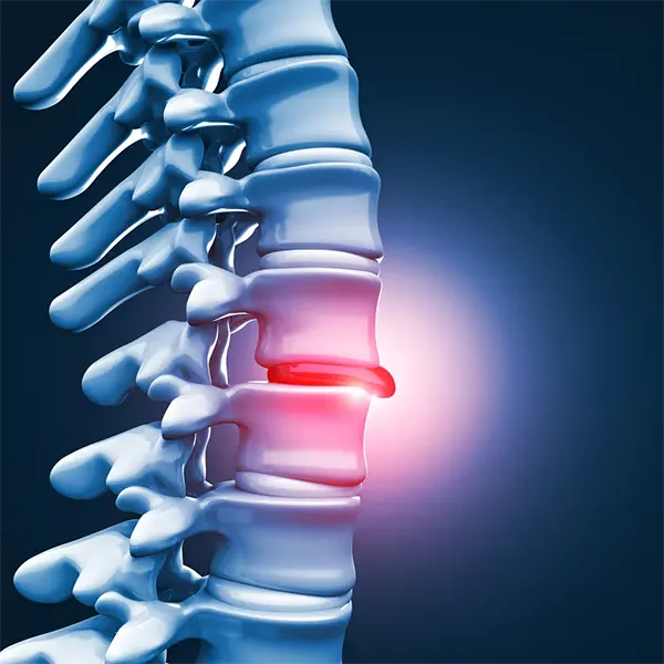 Disc Injury Treatment Near Me in Lincoln, NE. Chiropractor For Disc Injury Pain Relief.